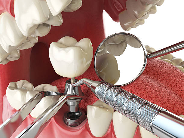 Best Emergency Root Canal Treatment in Fayetteville, NY